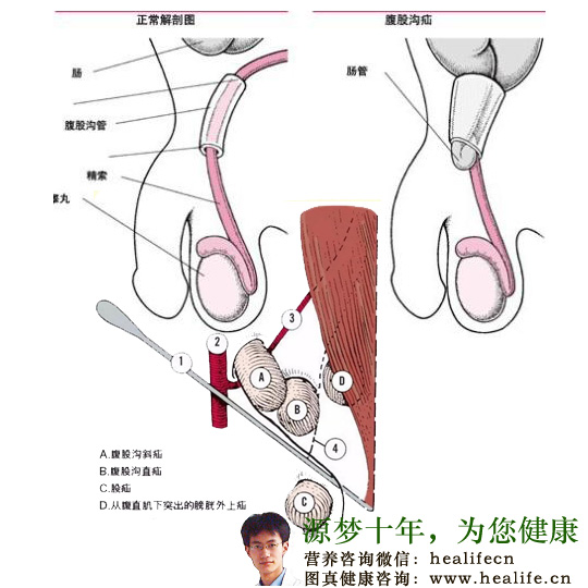 腹股沟疝