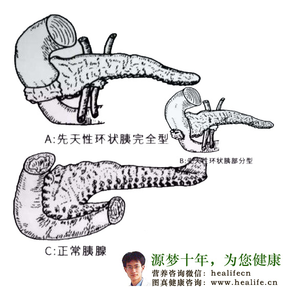 先天性消化道畸形