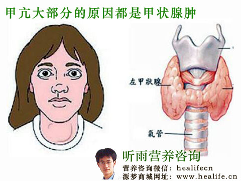 甲亢大部分的原因都是甲状腺肿