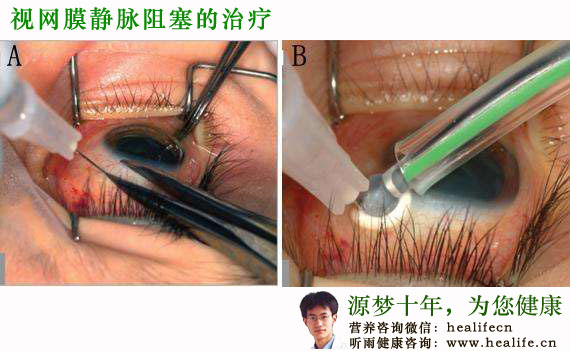 视网膜静脉阻塞