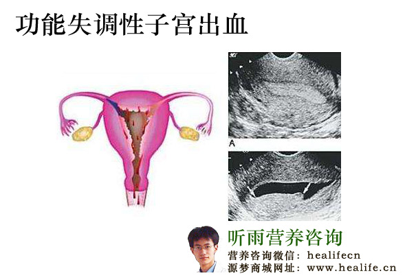 阴道非正常流血