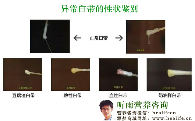 异常白带的性状鉴别