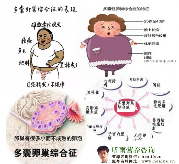 多囊卵巢综合征