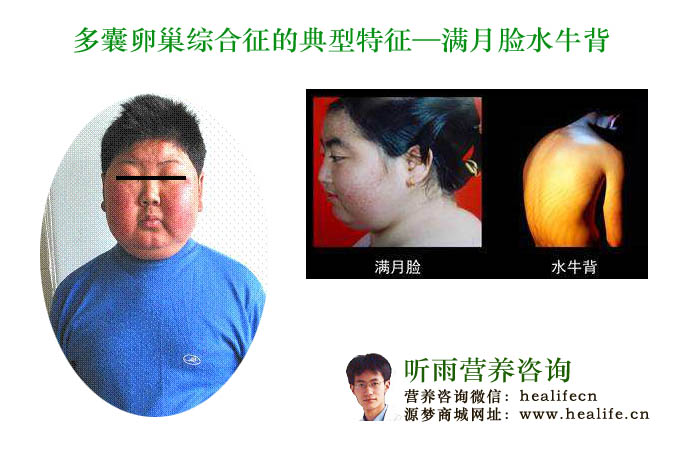 多囊卵巢综合征的典型特征-满月脸水牛背