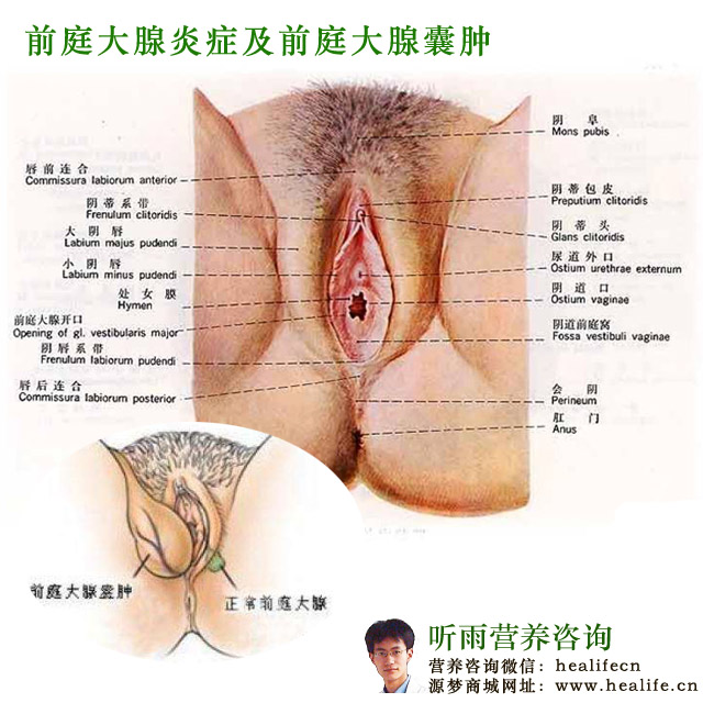 前庭大腺炎症及前庭大腺囊肿