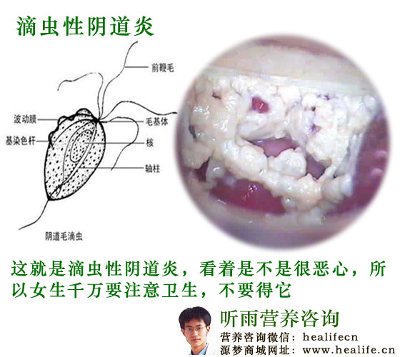 滴虫性外阴炎