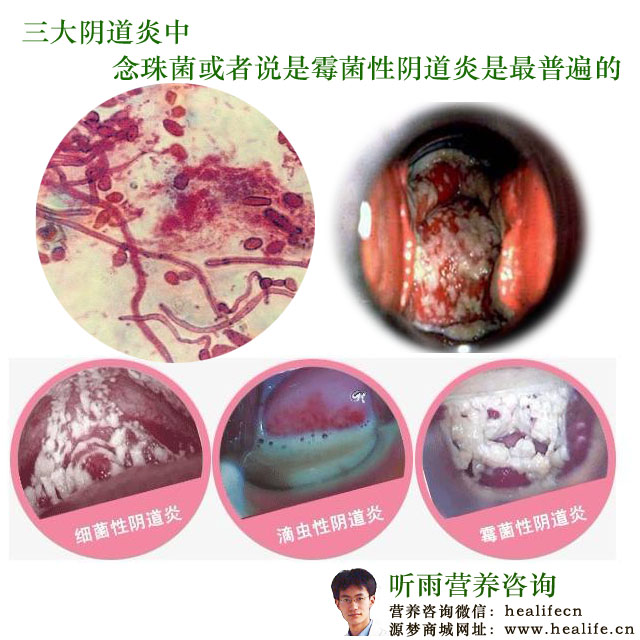 三大阴道炎中最普遍的就是念珠菌性阴道炎或者说是霉菌性阴道炎
