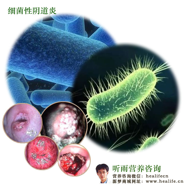 细菌性阴道炎