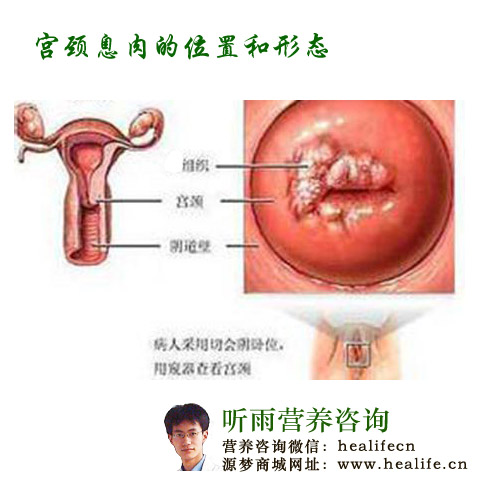 宫颈息肉的位置和形态