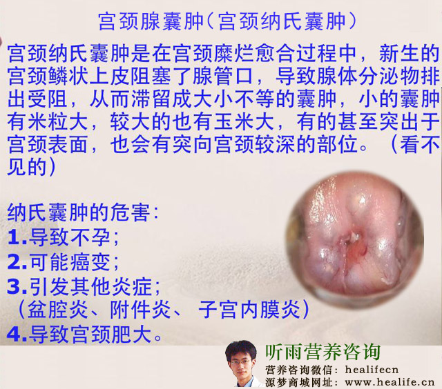 宫颈腺囊肿(宫颈纳氏囊肿)