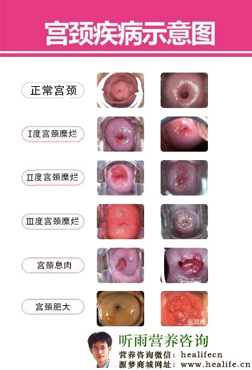 宫颈疾病示意图