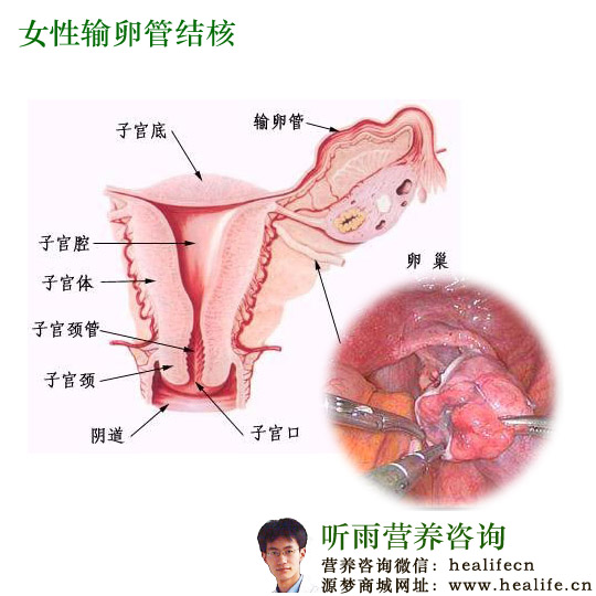 女性输卵管结核