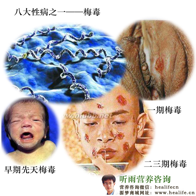 可怕的八大性病之一——梅毒