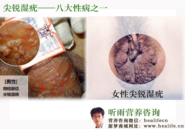 尖锐湿疣—八大性病之一