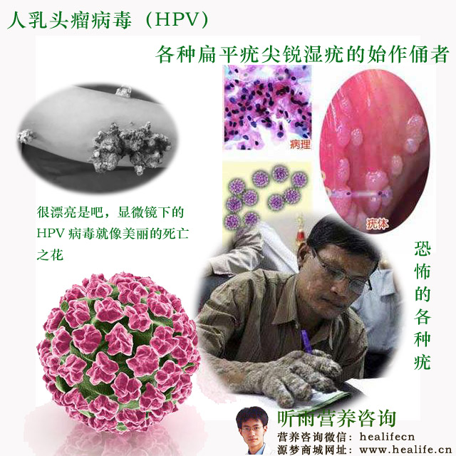 恐怖的人乳头瘤病毒(HPV)