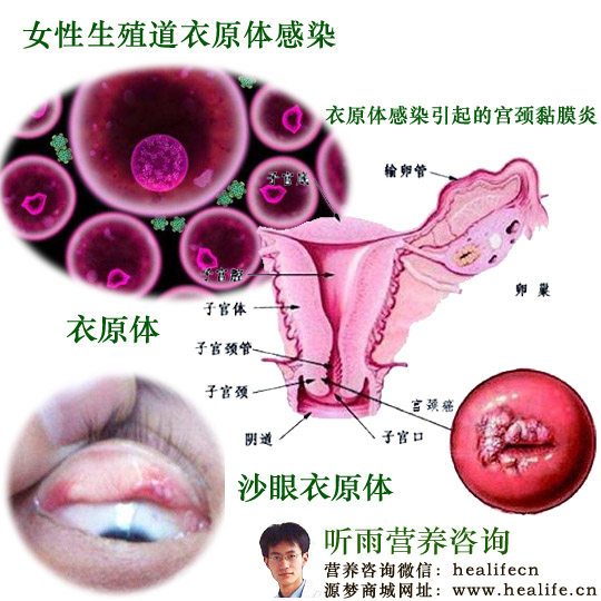 女性生殖道衣原体感染