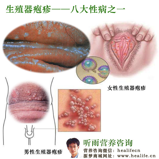生殖器疱疹