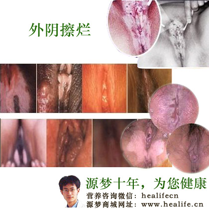 外阴擦烂