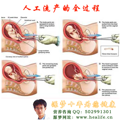 人工流产全过程