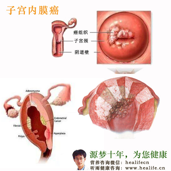 子宫内膜癌