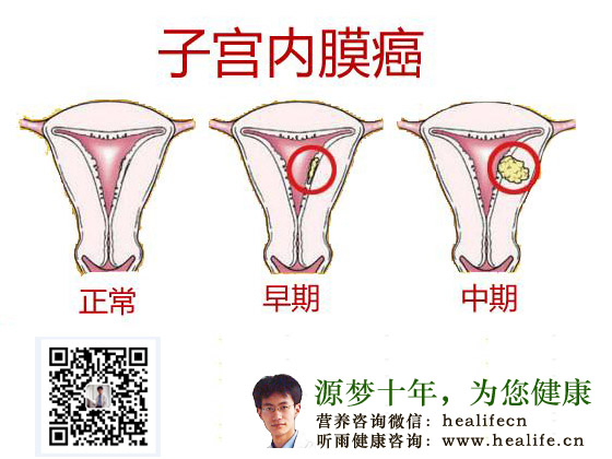 子宫内膜癌