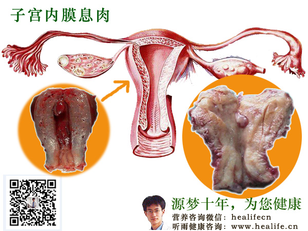 子宫内膜息肉