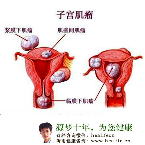 子宫肌瘤