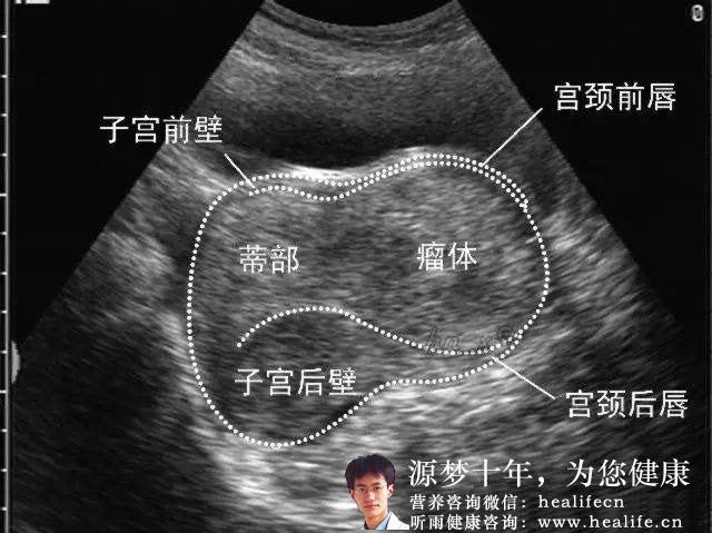 子宫肌瘤B超图谱