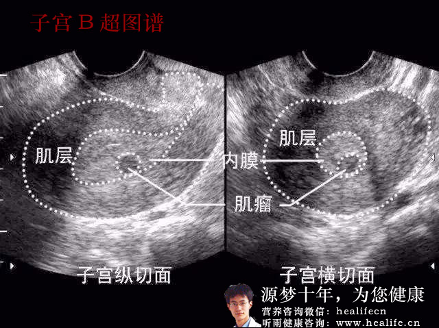 子宫B超图谱