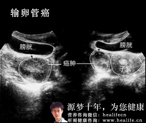 输卵管癌