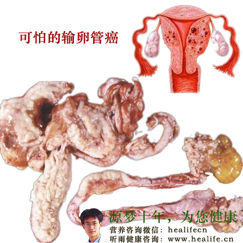 可怕的输卵管癌