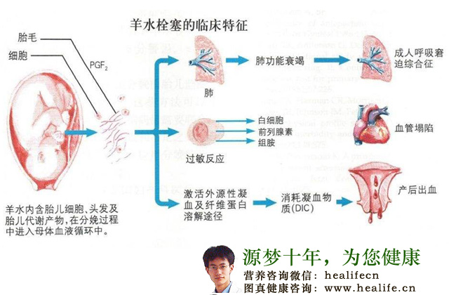 羊水栓塞的临床特征