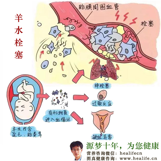 羊水栓塞