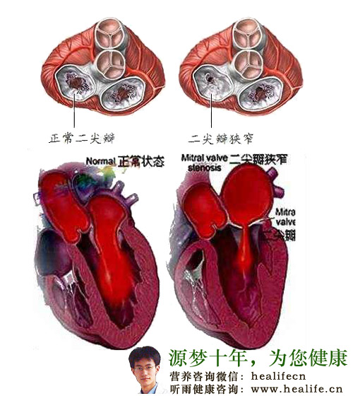 风湿性二尖瓣狭窄