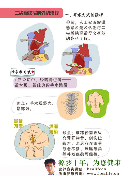二尖瓣狭窄的外科治疗