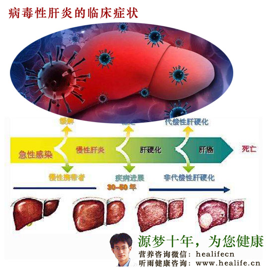 病毒性肝炎的临床症状