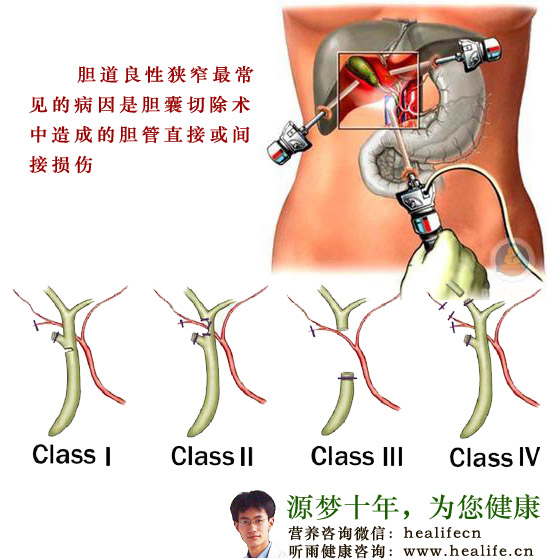胆管良性狭窄