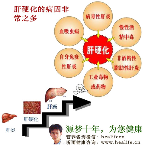 肝硬化的病因非常之多