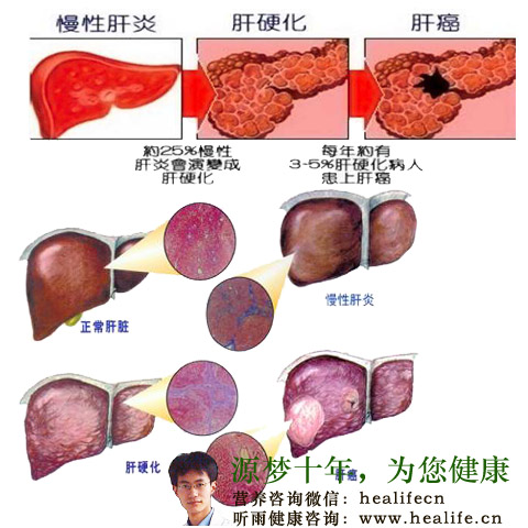 肝硬化的临床症状