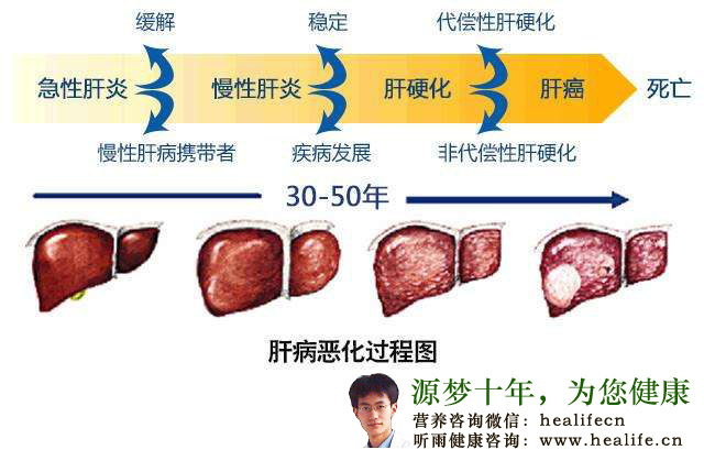 肝病恶化过程图