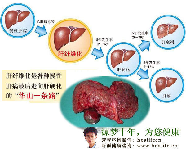 肝硬化