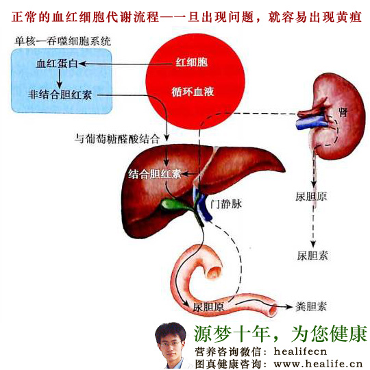 黄疸