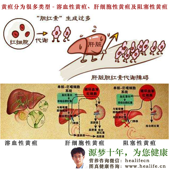 黄疸分为很多种类型