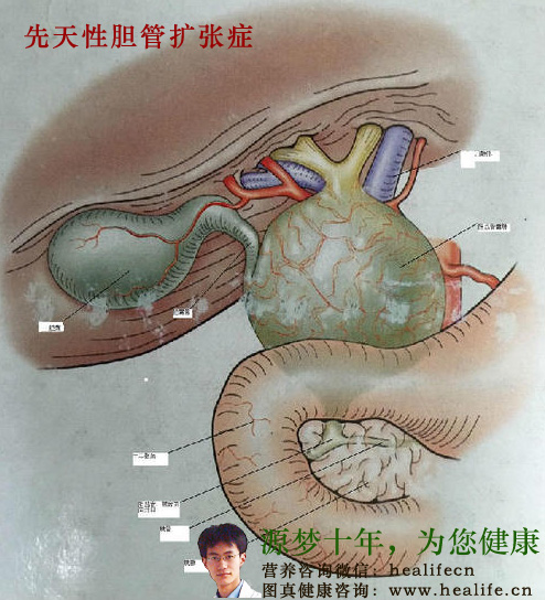 先天性胆管扩张症