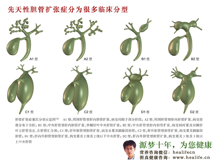 先天性胆管扩张症分为很多临床分型