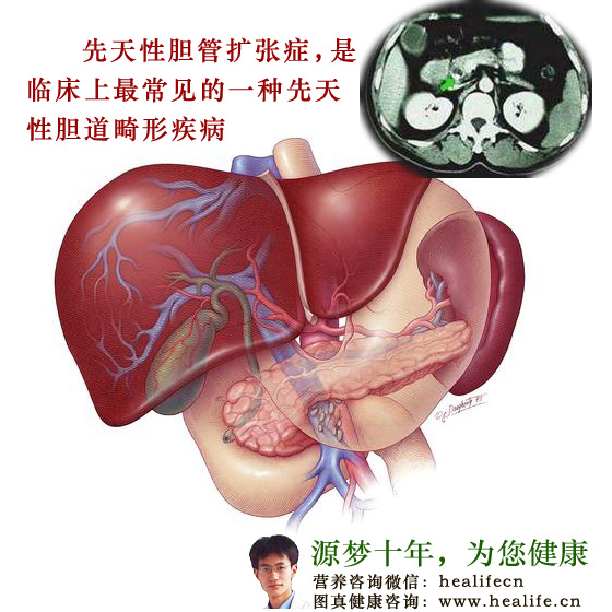 先天性胆管扩张症是临床上最常见的胆道畸形疾病