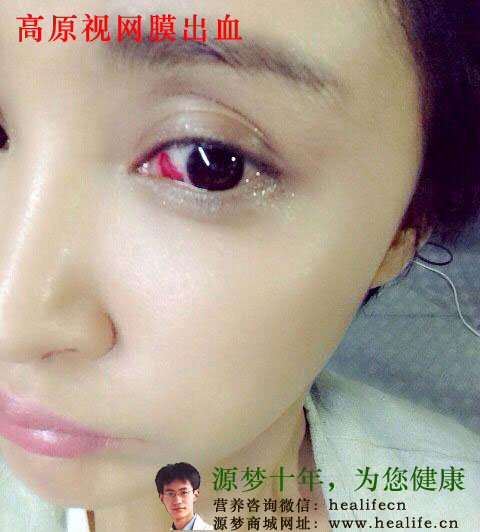 高原反应