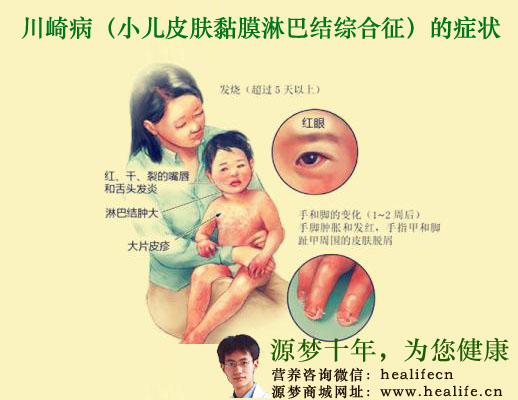 川崎病的症状