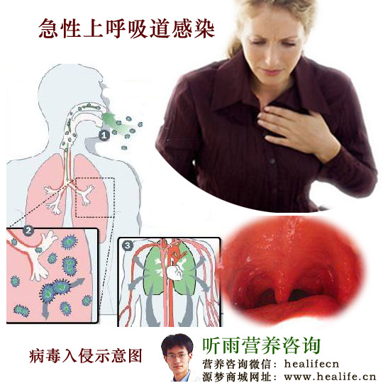 急性上呼吸道感染