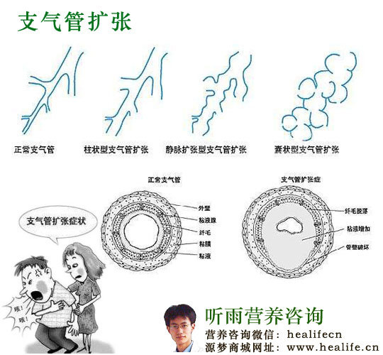 支气管扩张